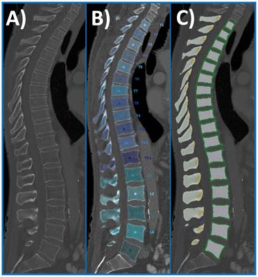 Sex differences and age-related changes in vertebral body volume and volumetric bone mineral density at the thoracolumbar spine using opportunistic QCT